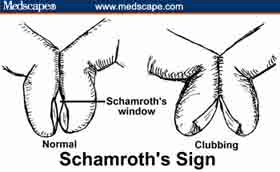 Schamroth's sign