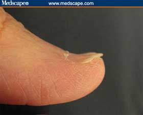 Abnormalities of the nails: spooned nail.