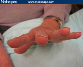 Thin nails with osteopenia