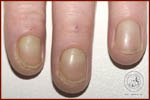 Yellow fingernails
