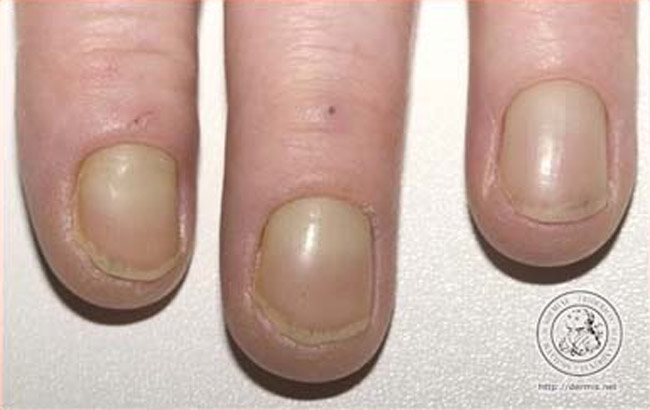 Yellow fingernails: causes & home remedies!