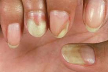 Suffer with white marks on your fingernails? this is what 