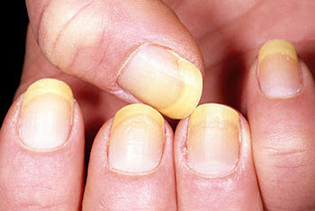 Yellow fingernails - example 1