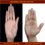 Finger length abnormalities: what can finger length reveal?