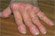 >The hand in Rheumatoid Arthritis!