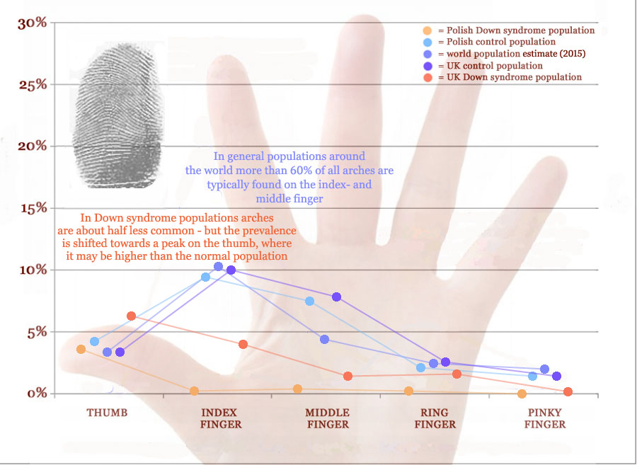 Arch fingerprint distribution across fingers in Down syndrome.