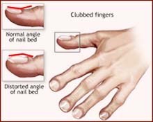 Fingernail clubbing, a.k.a. Hippocrates nails.