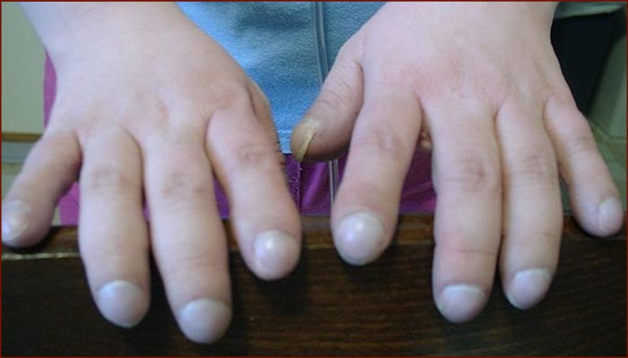Clubbing fingernails is a common characteristic in lung cancer.