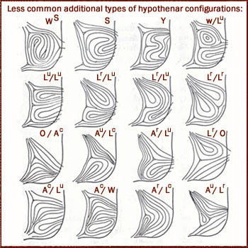 Additional dermatoglyphic hypothenar configurations - most are combinations of the basic types.