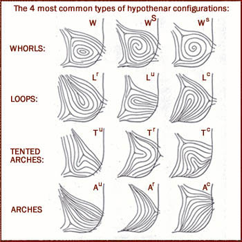 Dermatoglyphic hypothenar configurations - based on the 4 basic types: whorl, loop, tented arch & arch.