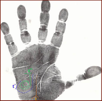 Dermatoglyphic whorl on the hypothenar - print.