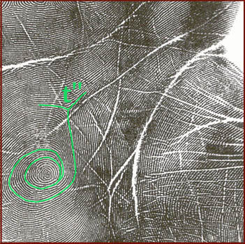 Dermatoglyphic whorl on the hypothenar - print.