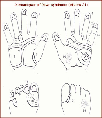 Down syndrome dermatogram: the typical dermatoglyphics in Down syndrome.