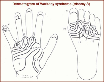 Warkany syndrome dermatogram: the typical dermatoglyphics in Warkany syndrome.