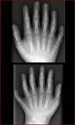 Devendra Harne has 12 fingers and 13 toes - his X-rays scan.