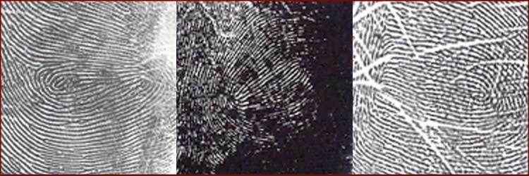 An impression from the hypothenar of 3 autistic people - showing a 'hypothenar composite whorl'.