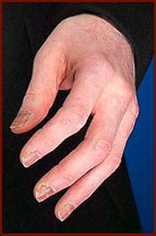 http://www.handresearch.com/news/pictures/michael-jackson-left-hand-2006.jpg