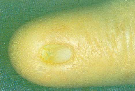 Micronychia: a small fingernail.