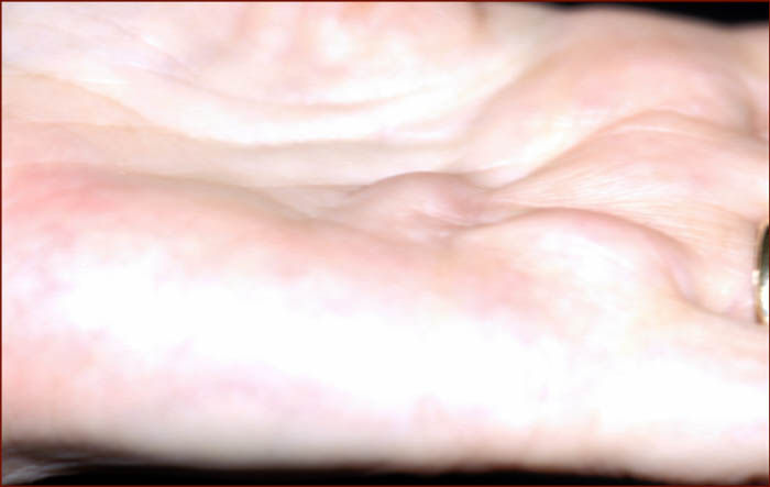 Palmar fascial thickening is a common characteristic in ovarian cancer.