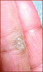 Voorbeeld van 'palmar keratosis': een papule op een vinger!