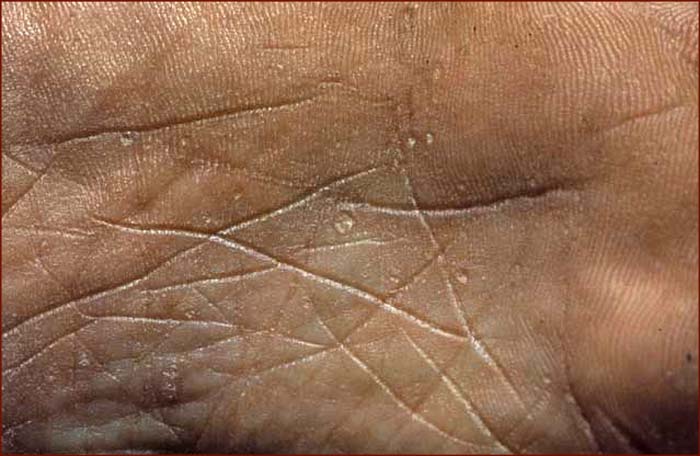 Palmar keratosis .