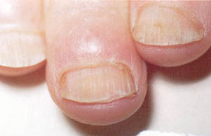 Racket nail: broad, shortened fingernail.