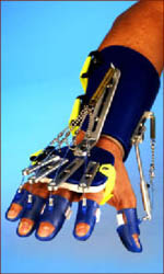 Saeboflex prosthetic hand.