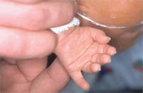 The simian line in a baby hand.