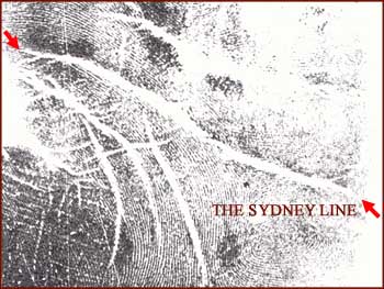 The Sydney line: a 'long head line', or 'extended proximal palmar crease'.