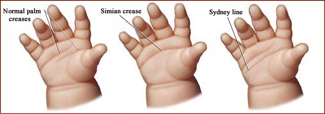 A simian related heart line.