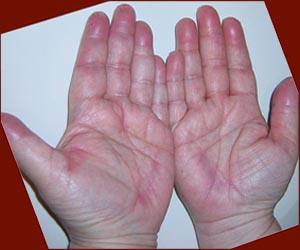 The 'hand-foot syndrome' includes skin reactions in the hands & feet due to chemotherapy.