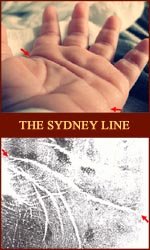 The Sydney line: a 'long head line', or 'extended proximal palmar crease'.