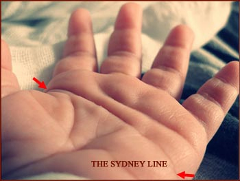 The Sydney line: a significant sign in Down's syndrome!