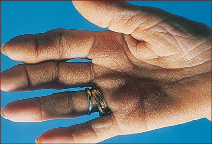 Tripe palms - a hand skin characteristic associated with cancer.