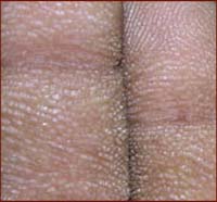 Hands on cancer: tripe palms & skin conditions.