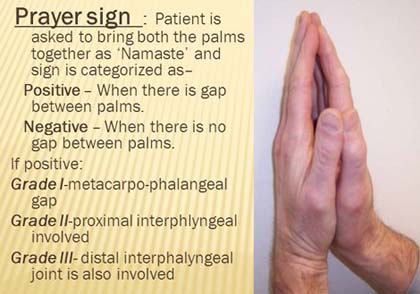 The hand in diabetes mellitus: the prayer sign.