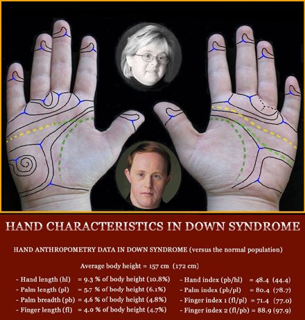 Phantom picture for the hand in Down syndrome (trisomy 21): hand anthropometry + dermatoglyphics + major palmar lines.