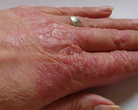 The hand in psoriasis: skin scales.