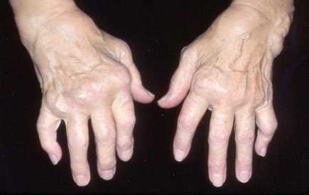 Hands affected with rheumatoid arthritis.