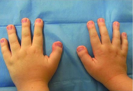Hand impression for Rubinstein-Taybi syndrome: broad thumbs.
