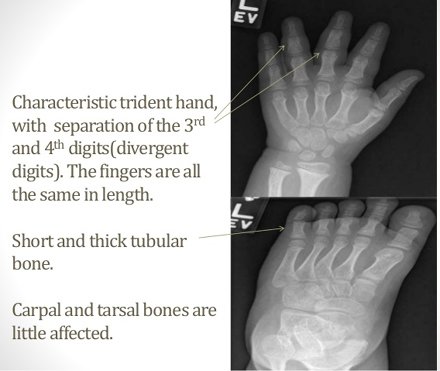 Trident hand in achondroplasia.