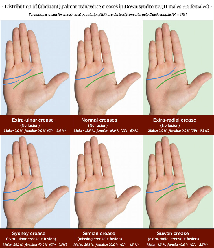 Distribution of (aberrant) palmar transverse creases in Down syndrome: Sydney creases, simian creases & Suwon creases.