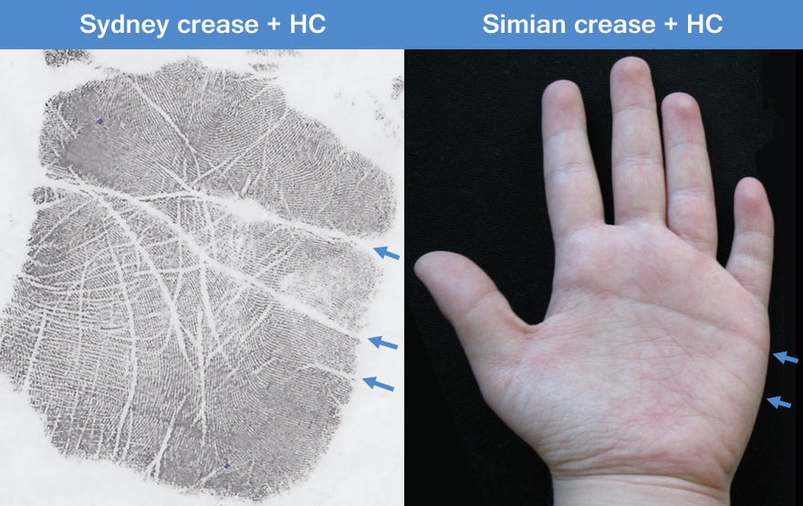 Down syndrome examples: hypothenar crease combined with Sydney crease / simian crease.