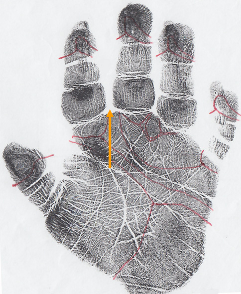 A considerable minority of Down syndrome cases has a long closed termination of the proximal transverse crease.