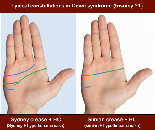 Typical constellations for the palmar transverse creases in Down syndrome: simian crease or Sydney crease combined with a hypothenar crease.