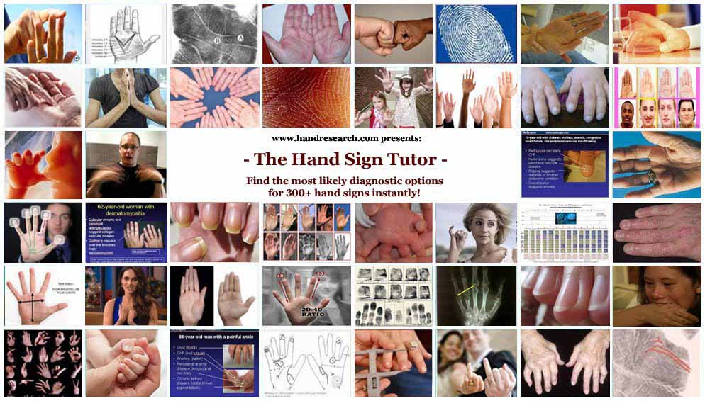 Hand Sign Tutor: find the most likely diagnostic options for 300+ hand signs instantly!