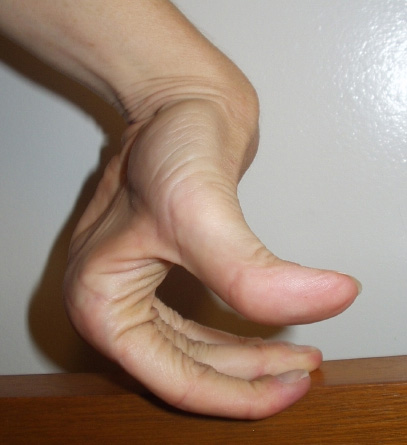 Example of hyperextensible finger joints: beyond normal range of motion.
