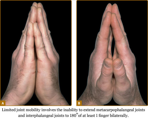 Limited joint mobility involves the inability to extend metacarpophalangeal joints and interphalangeal joints to 180 degrees of at least 1 finger bilaterally.