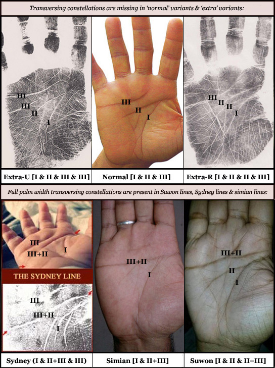 Palmar transverse crease variations: normal - double - Suwon crease - Sydney crease - simian crease.