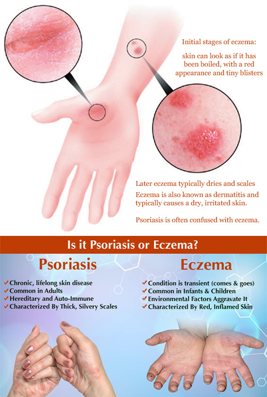 Red skin: eczema vs. psoriasis.